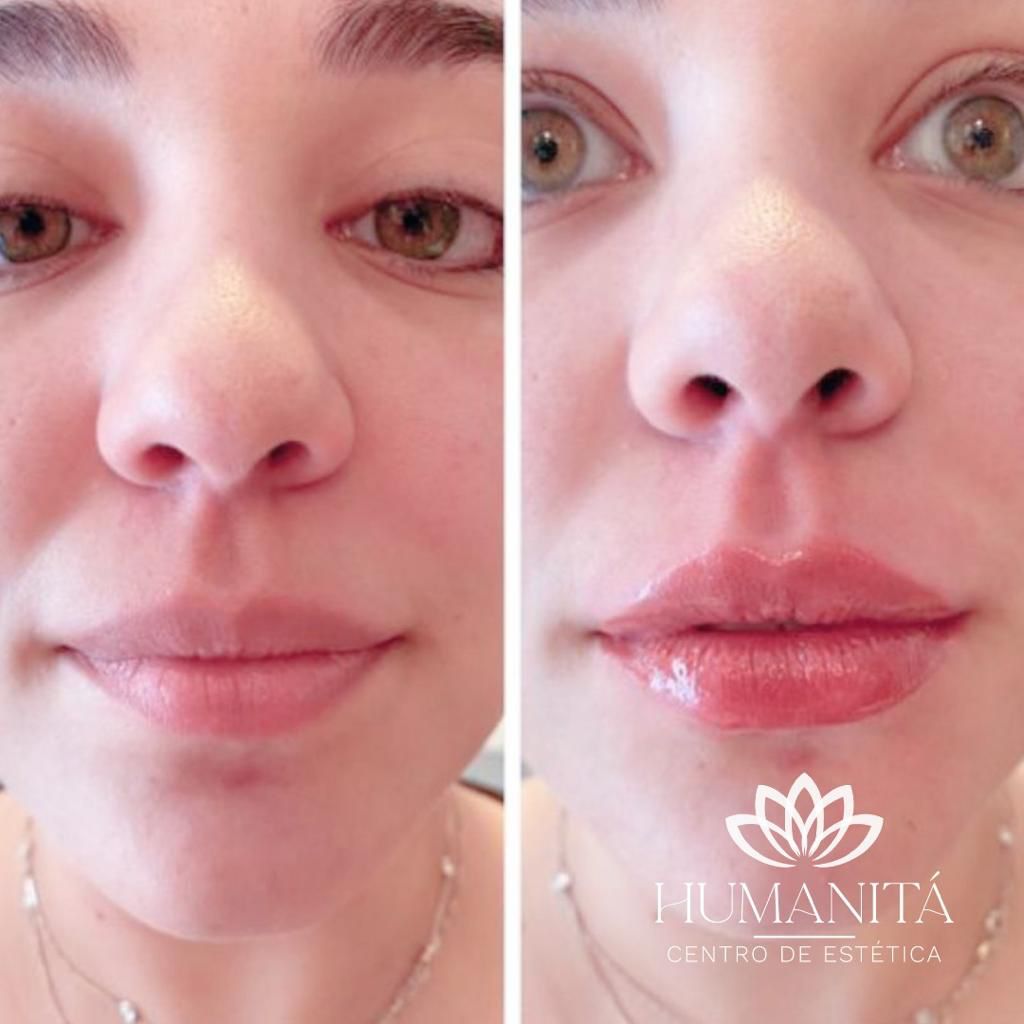 Preenchimento labial antes e depois moema sp