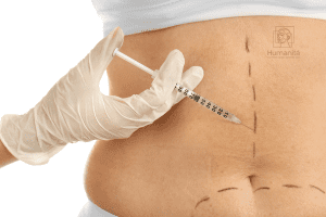 Em busca de um método eficaz e seguro para alcançar o corpo dos seus sonhos? A lipo enzimática tem se destacado como uma alternativa popular para aqueles que desejam emagrecer de maneira localizada e com resultados visíveis. Na Clínica Humanitá, entendemos que cada pessoa é única, e é por isso que oferecemos uma abordagem personalizada para garantir que você alcance seus objetivos de emagrecimento com saúde e confiança.