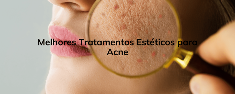 Descubra os melhores tratamentos estéticos para acne neste guia abrangente. Conheça opções eficazes para tratar a pele acneica e conquiste uma pele mais saudável e radiante. Saiba mais agora!