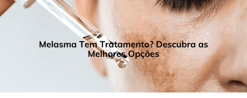 Melasma Tem Tratamento? Descubra as Melhores Opções