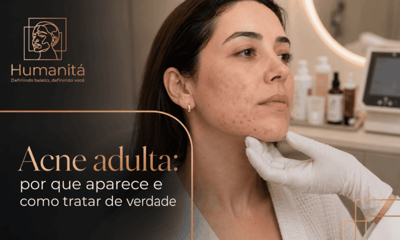 Acne adulta: por que aparece e como tratar de verdade